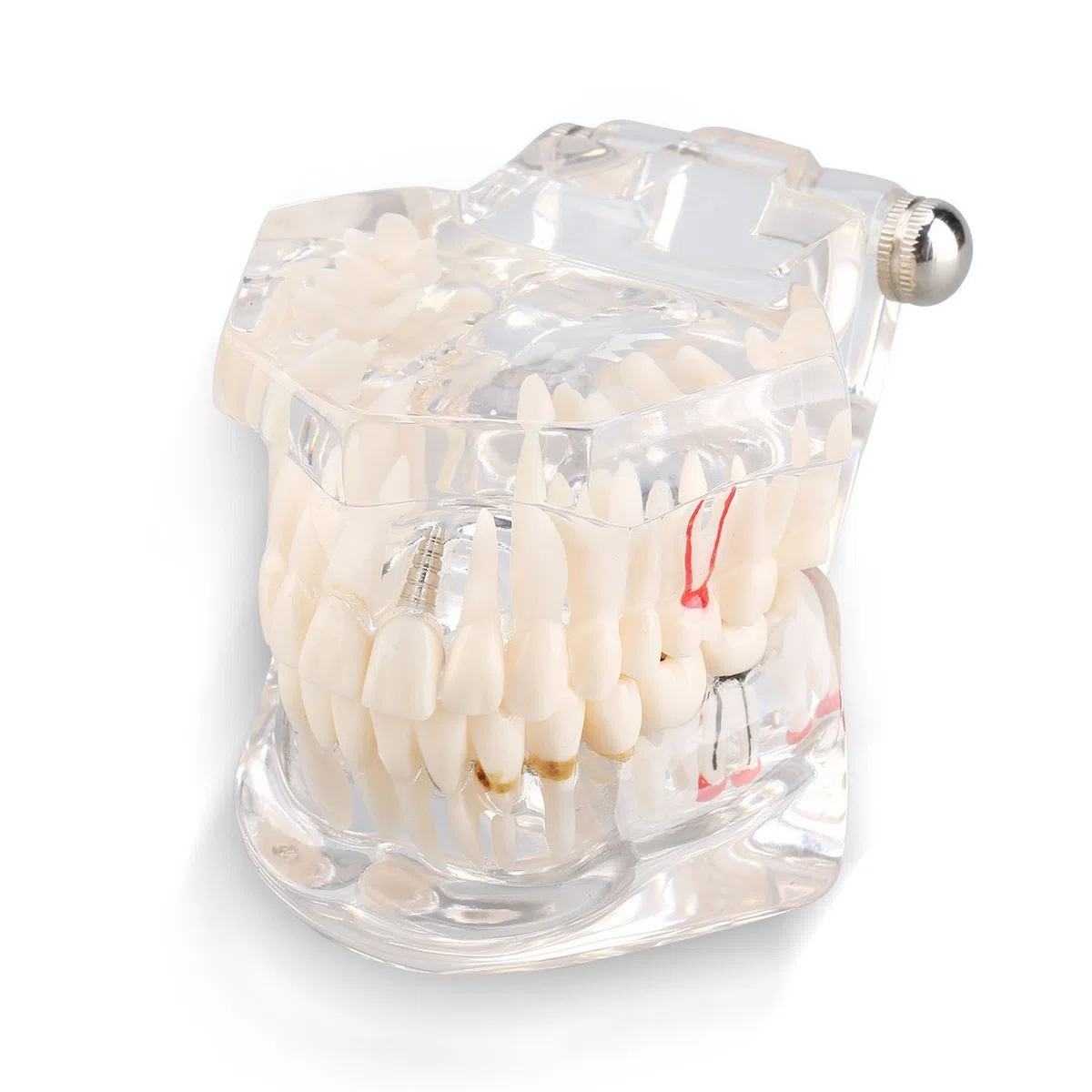 Yosoo transparent Erwachsenen Pathologien Dental Implant Zahnarzt Parodontalerkrankungen Demonstration ASSORT Zähne Zahnfleisch Zahnpflege Unterricht Studio Standardmodell Typodont - Abnehmbarer