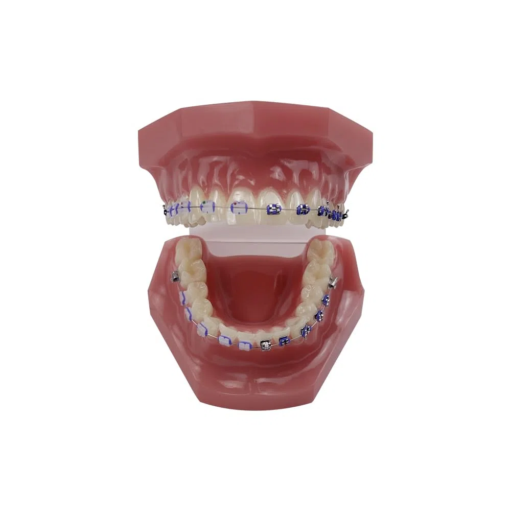 Orthodontisches Zahnmodell mit Halterungen, YOUYA DENTAL Demonstration Orthodontisches Modell für Bildung, Zähne Demonstration Typodonte Anatomisches Lehrwerkzeug mit Metall und Keramischer Halterung