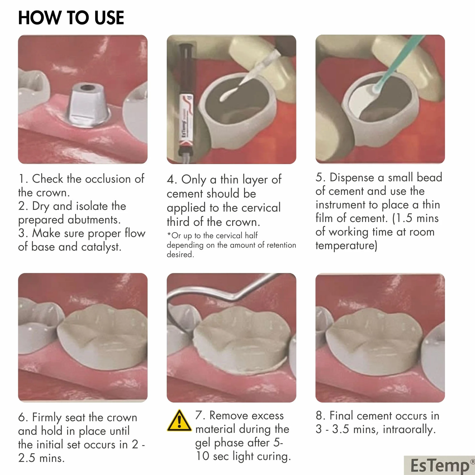 Permanenter Zahnzement für Kappen, Kronen, Brücken, Inlays, Onlays, Implantate, Veneers ESTEMP